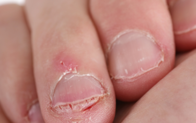 How Bipolar II disorder affects people who are suffering from it.